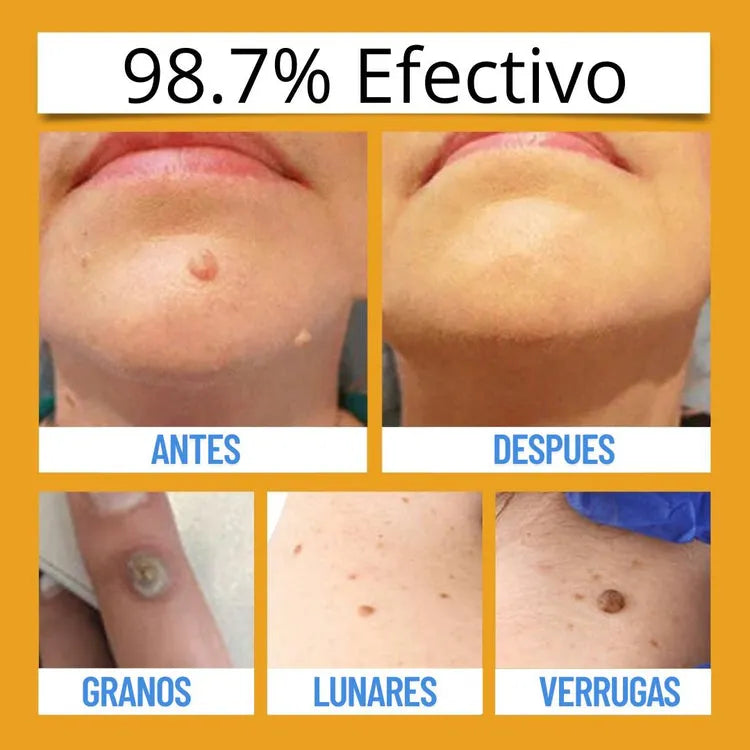Spray Eliminador de verrugas Tag Recede